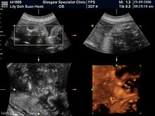 Vivian Sonograms